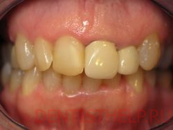 Зубы лечение серый цвет thumbnail